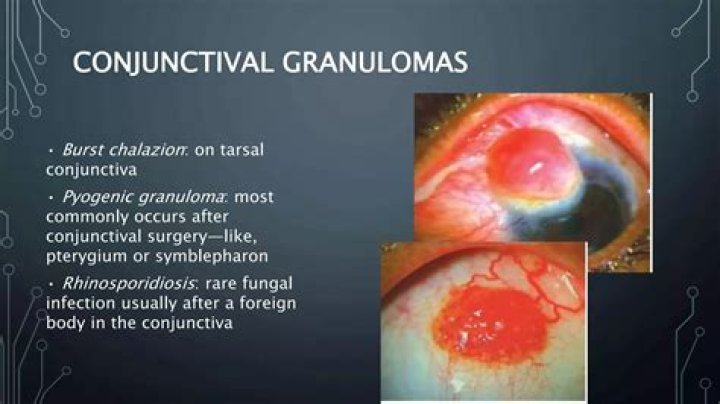 Are pyogenic granulomas cancerous?