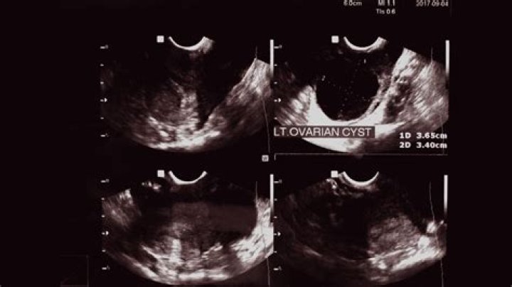 Can a cyst be hypoechoic?