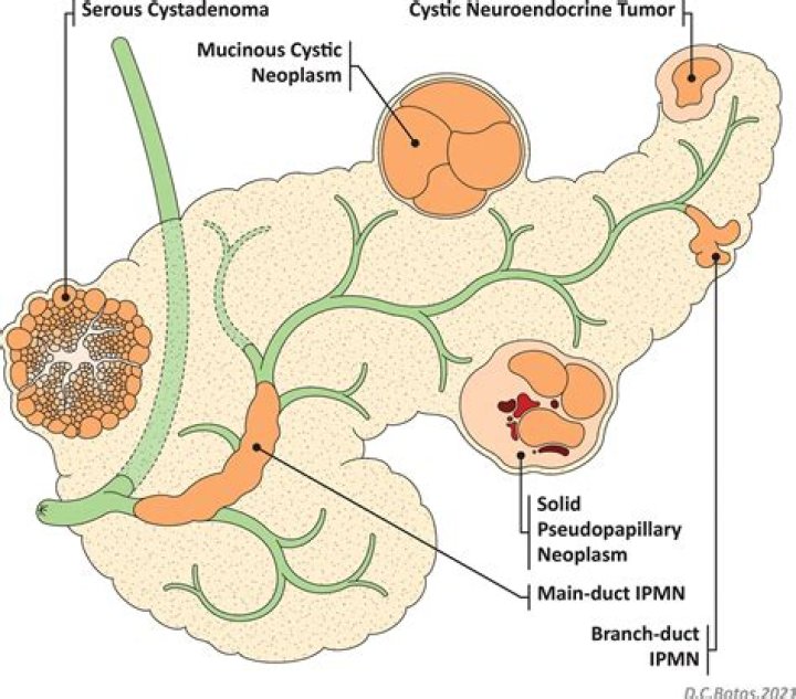 Can a cystadenoma cause pain?