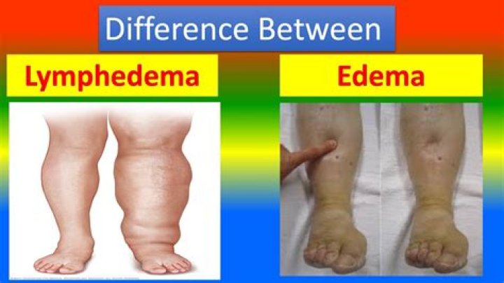 Can a nurse be lymphedema certified?