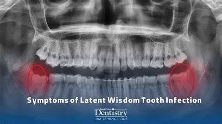 Can a wisdom tooth infection spread to tonsils?