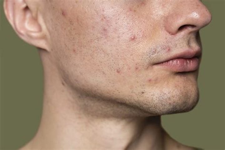 Can Clarisonic make acne worse?