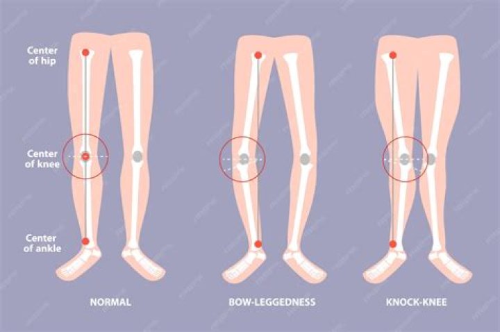 Can knock-kneed be corrected?