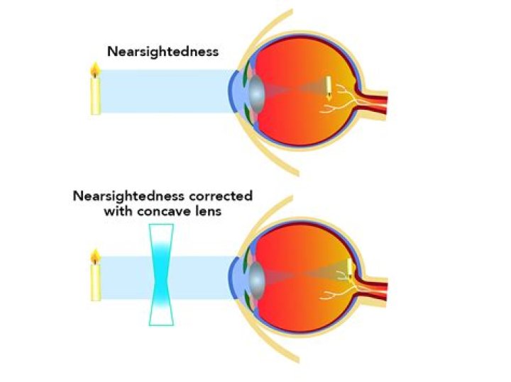Can laser eye treatment cure long sightedness?