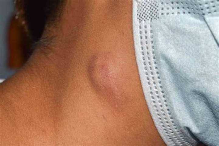 Can lymphoma lumps be small?