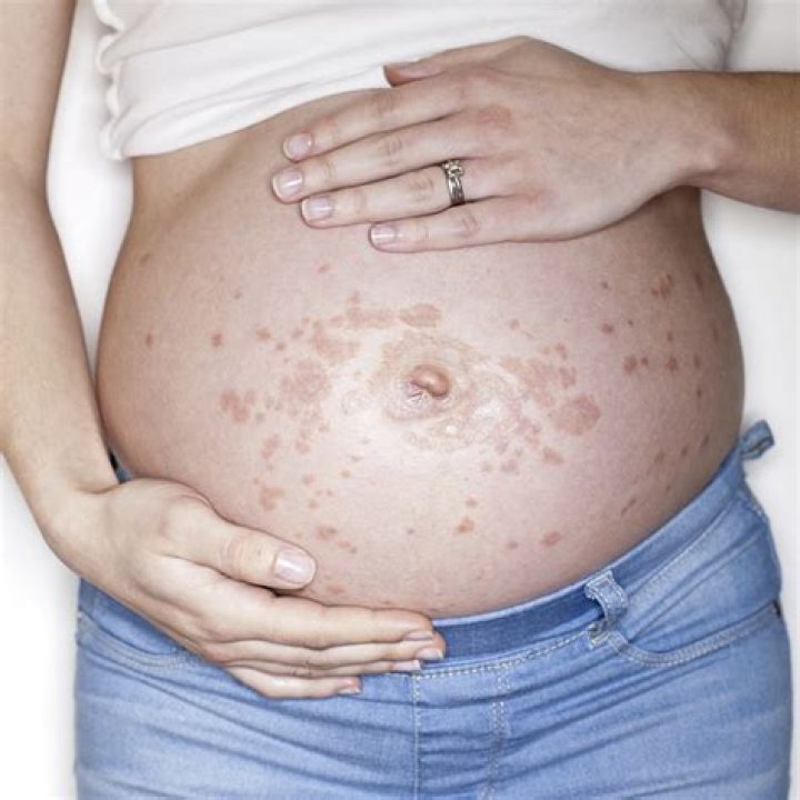 Can pregnancy cause rashes on hands?