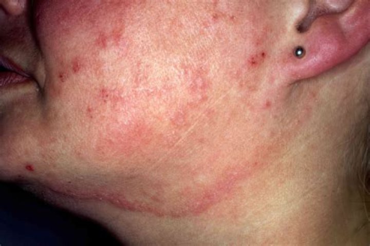 Can ringworm be mistaken for something else in dogs?