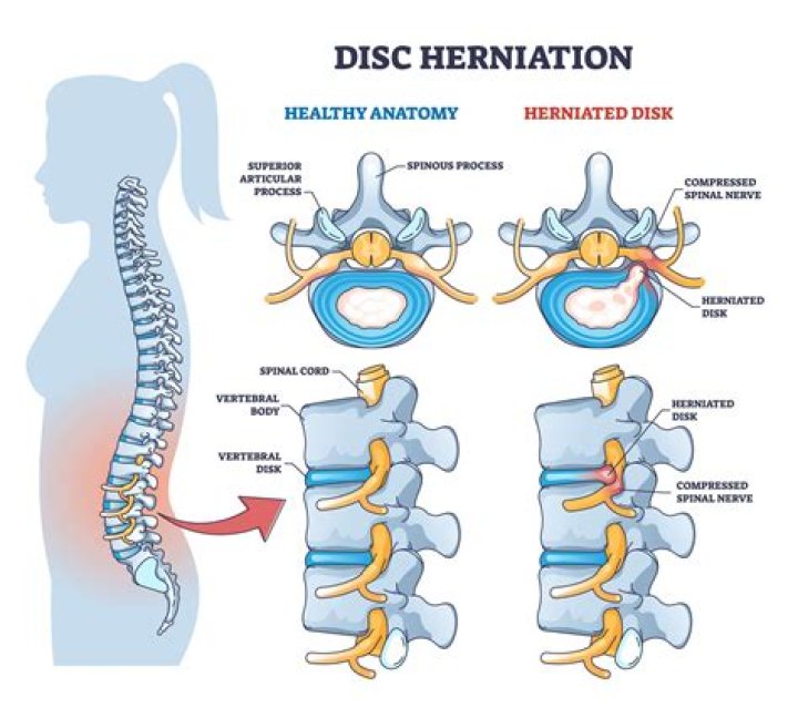 Can thoracic herniation cause chest pain?