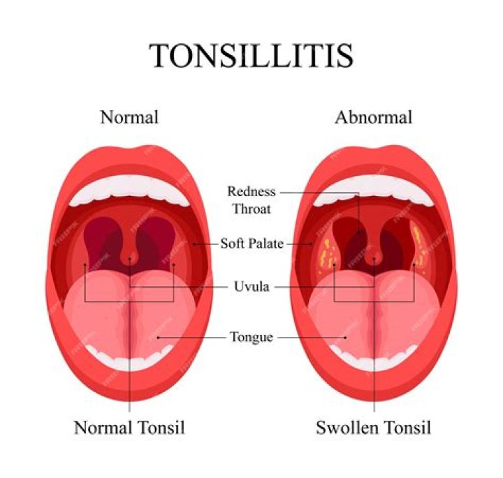 Can tonsillitis be cured permanently?