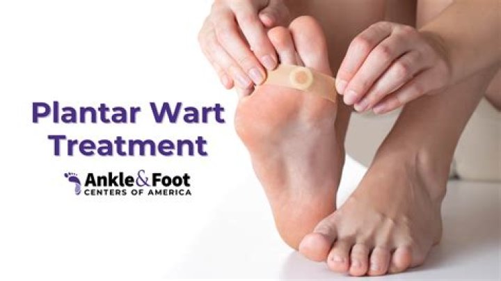Can you burn off a plantar wart?
