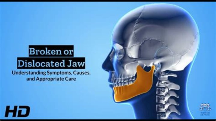 Can you get compensation for a broken jaw?