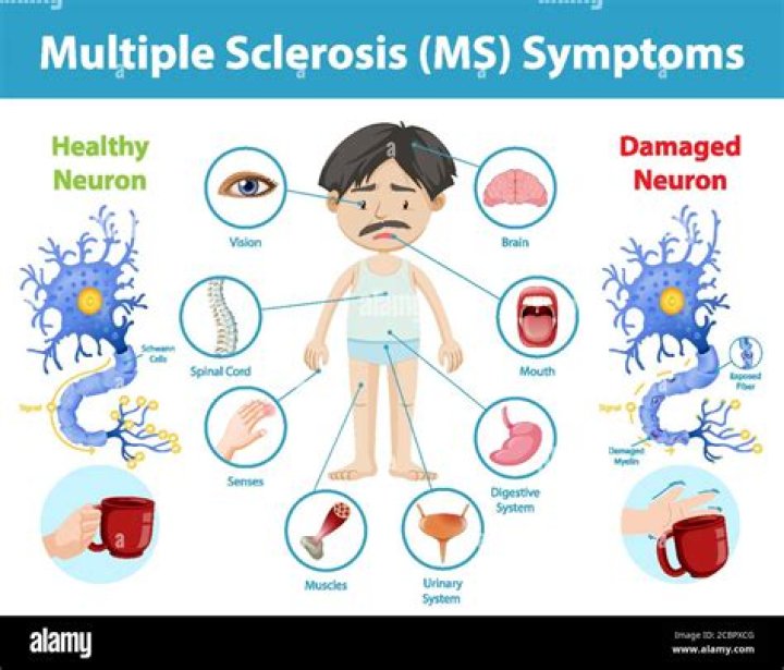 Can you have MS and CRPS?