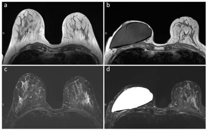 Can you see a partial ACL tear on MRI?
