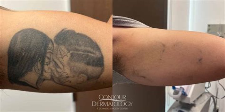 Can you speed up tattoo removal?