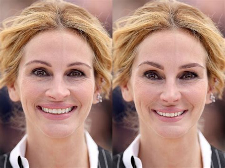 Comment corriger asymetrie visage?