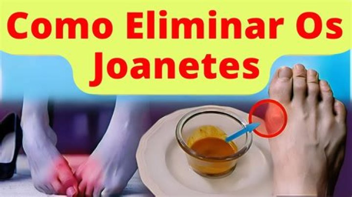 Como eliminar joanetes naturalmente?