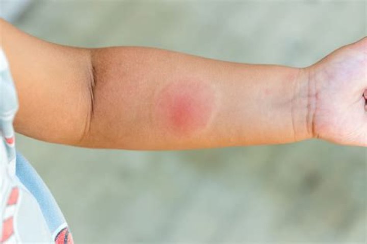 Do spider bites cause red streaks?