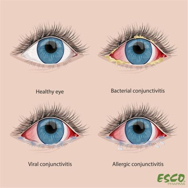 Does Blepharoconjunctivitis go away?