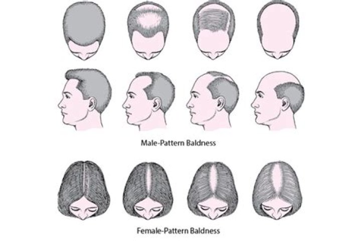 Does Bosley work for male pattern baldness?
