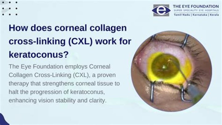 Does Cross Linking stop keratoconus?