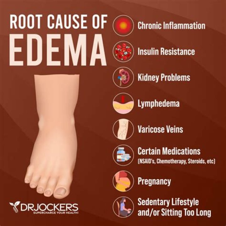 Does edema cause discoloration?