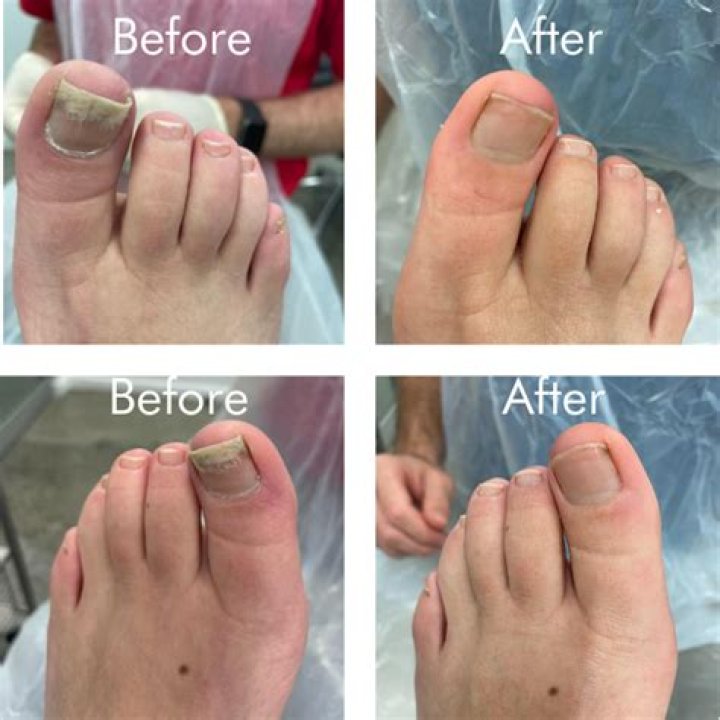 Does laser toenail fungus removal really work?