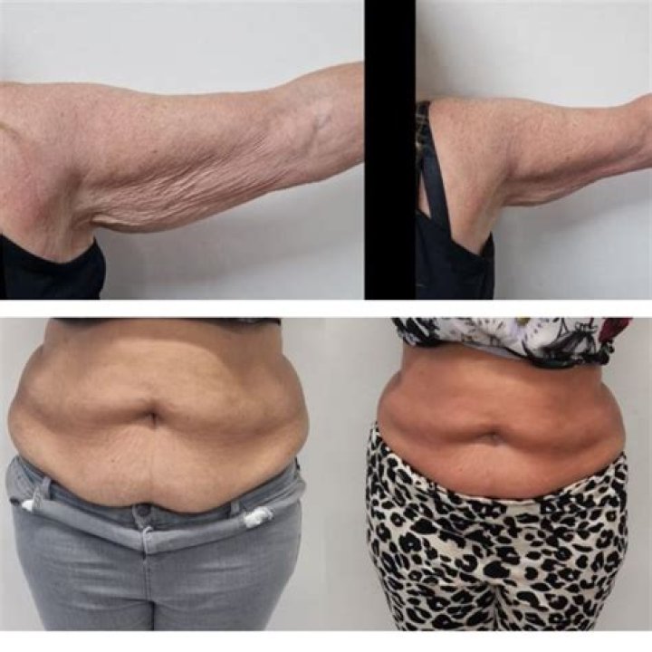 Does Lipo get rid of back fat?