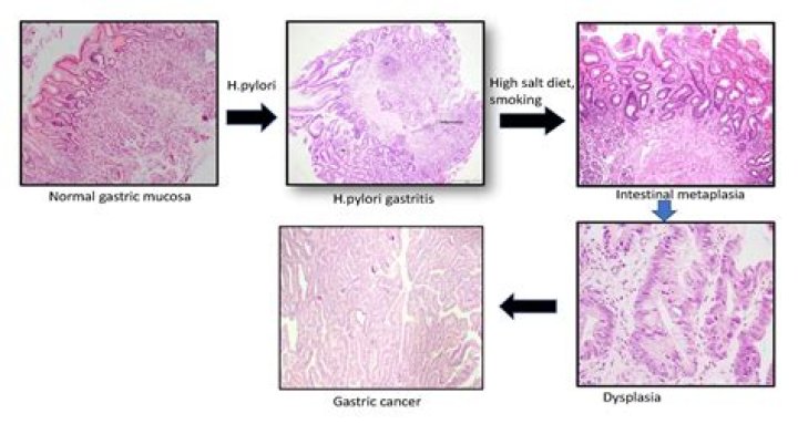 Does metaplasia lead to cancer?