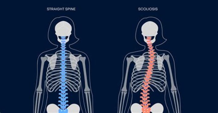 Does scoliosis affect the shoulder blade?