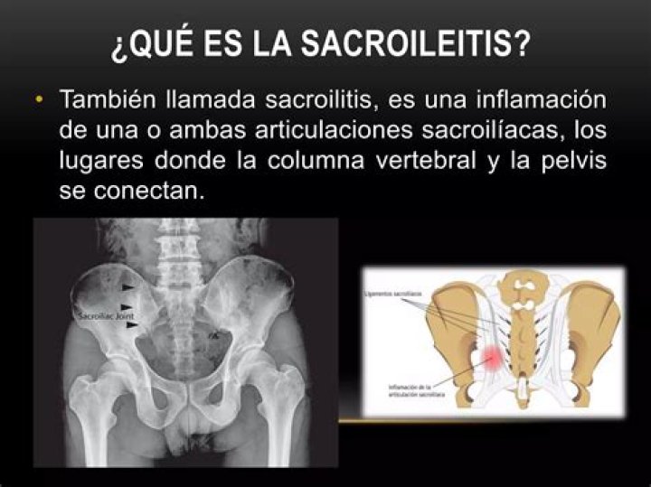 Donde duele la sacroileitis?