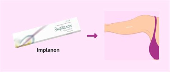 Has anyone got pregnant on Nexplanon?