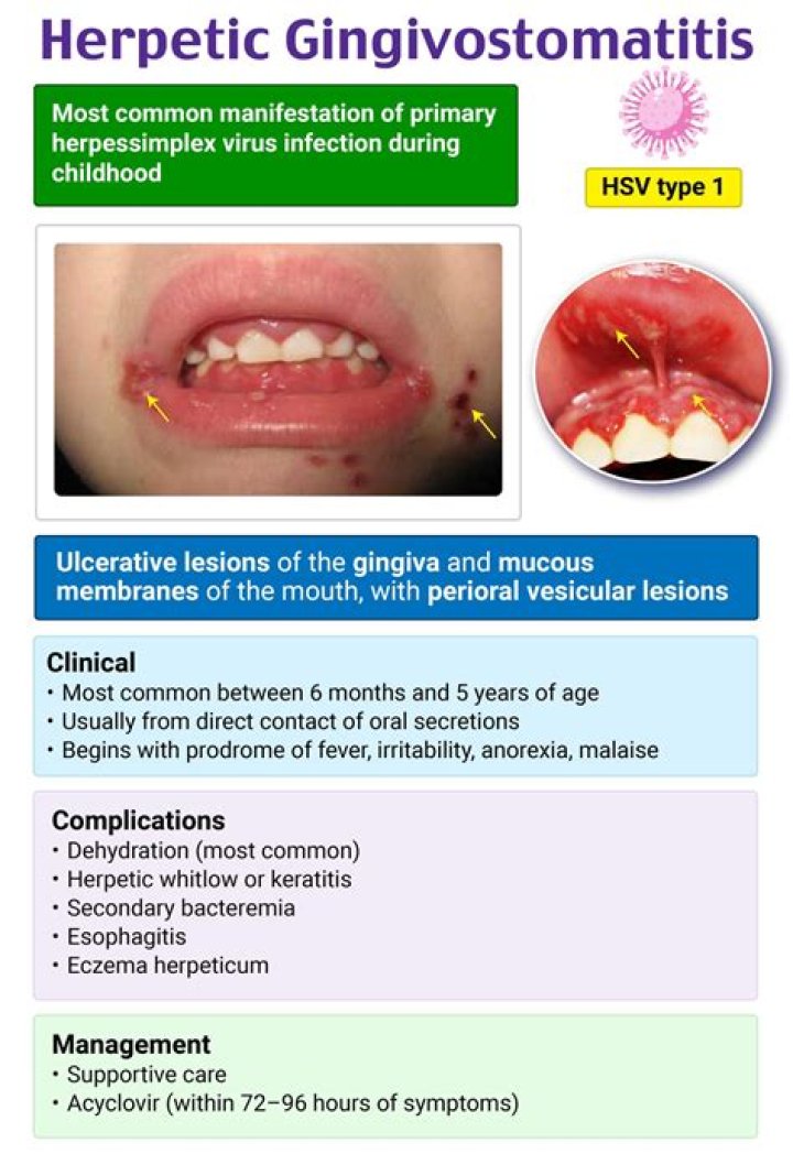 How did my toddler get Gingivostomatitis?