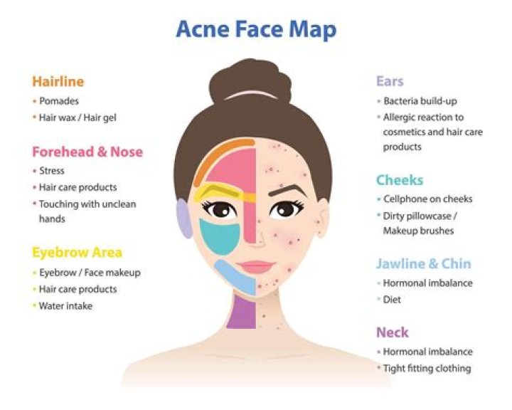 How do I stop acne breakouts fast?