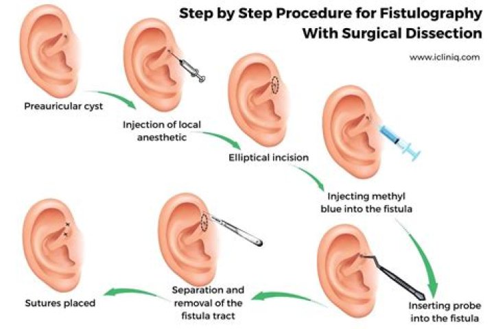 How do they remove Preauricular sinuses?