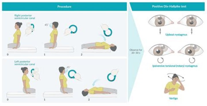 How do you elicit nystagmus in BPPV?