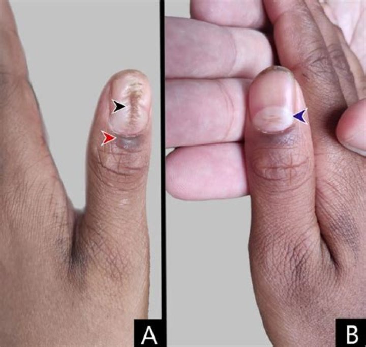 How do you fix the median nail dystrophy?