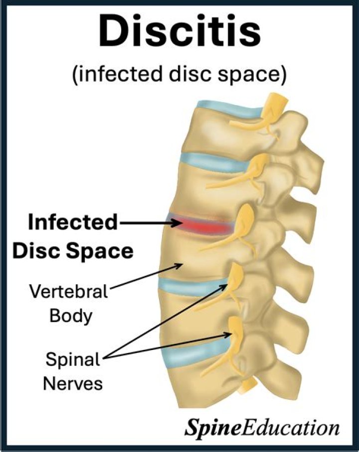How do you fix vacuum disc phenomenon?