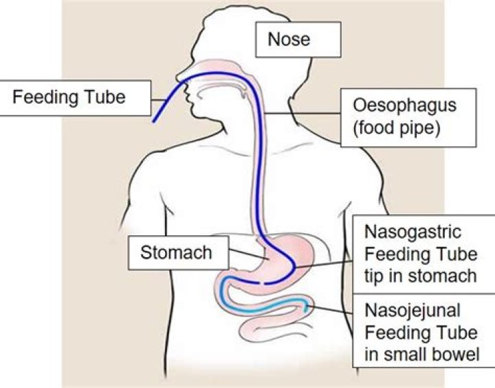 How do you insert a Nasojejunal tube?