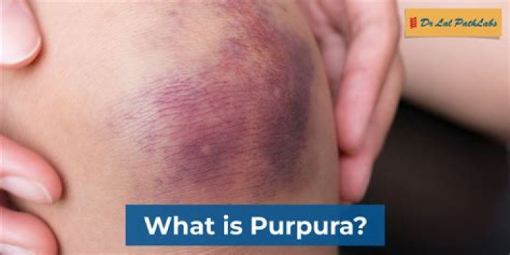 How do you remove purpura spots?