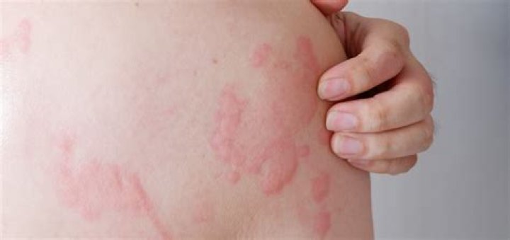 How do you test for urticaria pigmentosa?