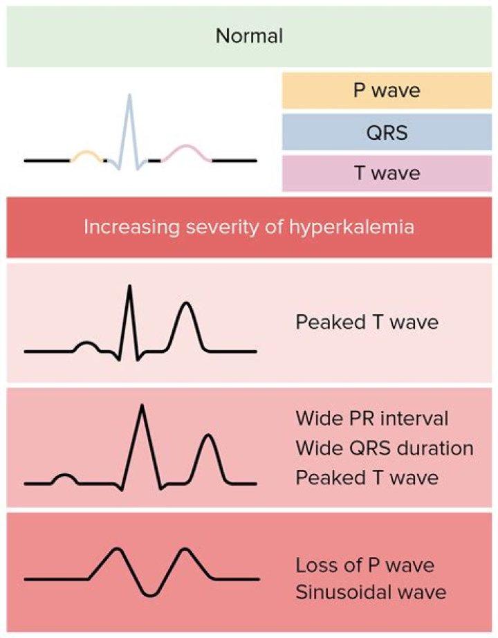 How does low potassium affect ECG?