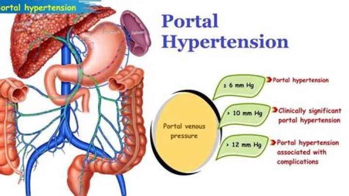 How does portal hypertension cause variceal bleeding?