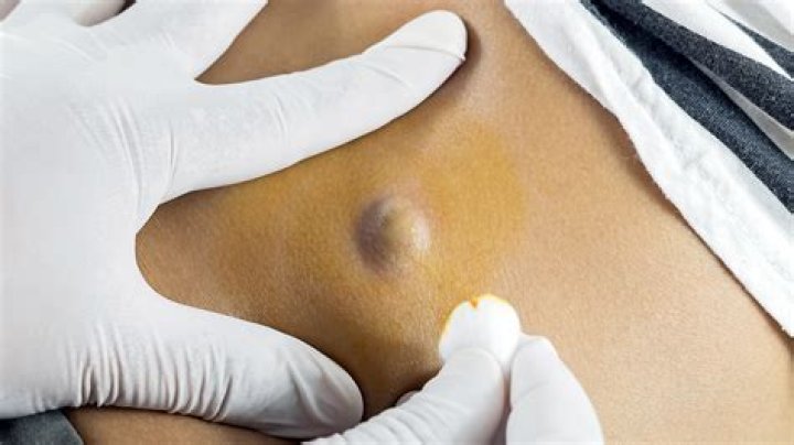 How is a colloid cyst removed?