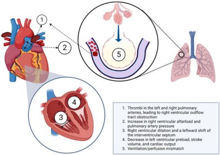 How is pulmonary embolism treated with hemoptysis?