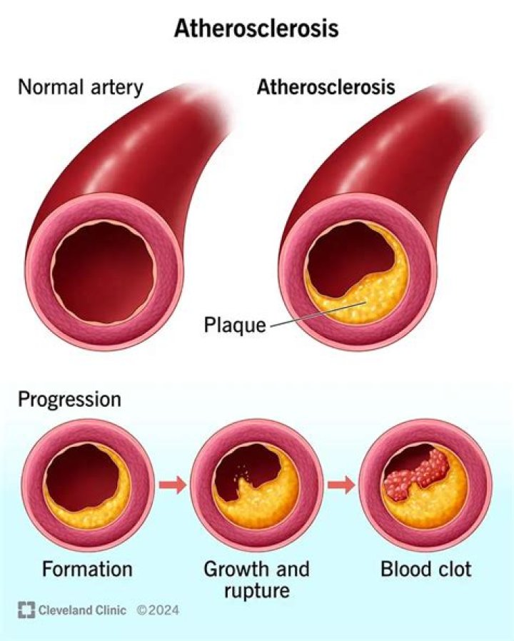 How is subclinical atherosclerosis diagnosed?