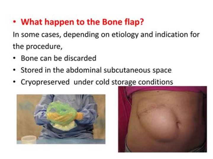 How long can a bone flap be stored?