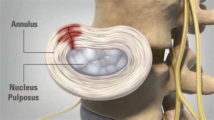 How long does a posterior annular tear take to heal?