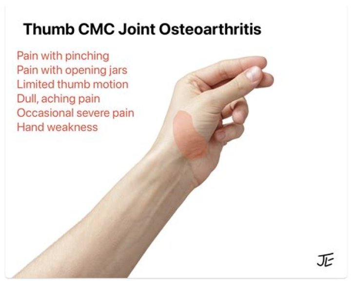 How long does a thumb joint replacement last?