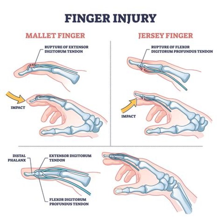 How long does it take to recover from mallet finger surgery?