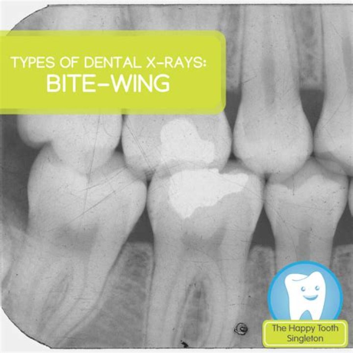 How much are bitewing X-rays?